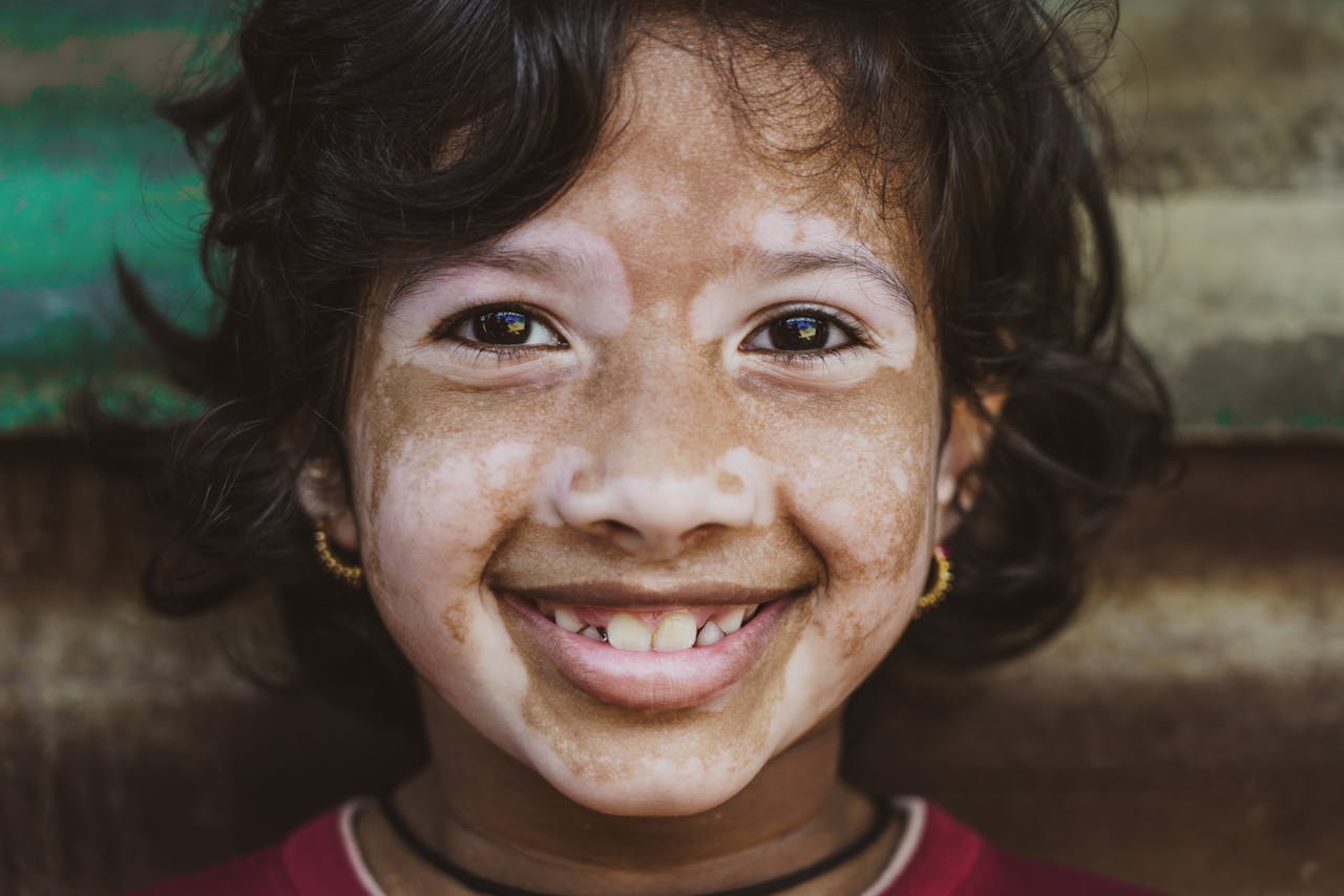 Vitiligo in Children and Teens